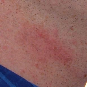 How To Eliminate Razor Burn And Irritation From Electric Shavers ...