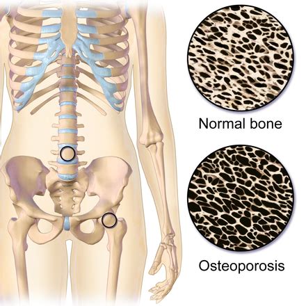 Osteoporosis - Wikipedia