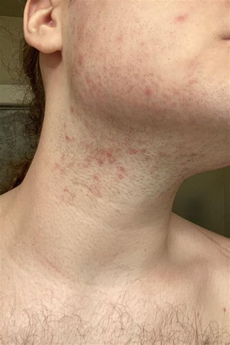 why is my skin like this after shaving? : r/BeardAdvice