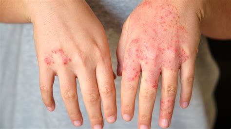 Red Spots On Skin: Here Are Its Common Causes And How To Get Rid Of Them | OnlyMyHealth