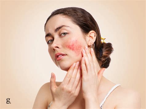 How to Soothe Irritated Skin on Your Face: 7 Effective Remedies – glooshi.