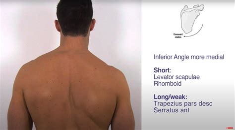 Upwardly Rotated Scapula