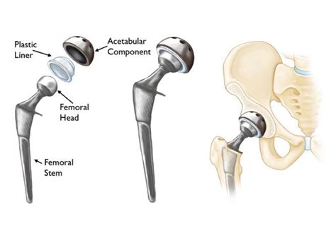 Total Hip & Anterior Hip Replacement Surgery by Dr David Slattery
