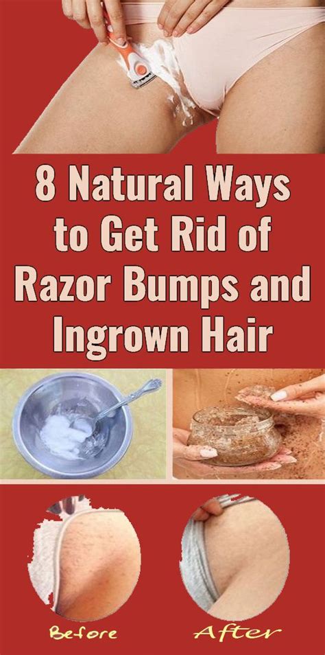 How to Get Rid of Ingrown Hairs Fast - Best Razor Bump Removal Tips | Ingrown hair, Skin bumps ...