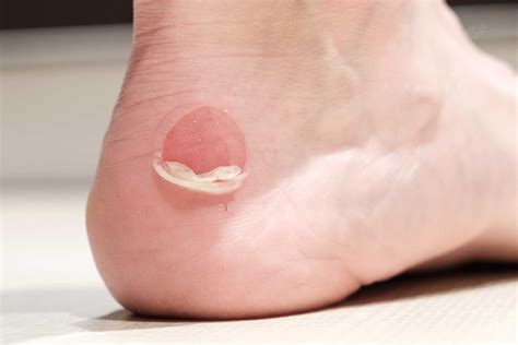Blisters Care for Feet - Tips from Shuman Podiatry and Sports Medicine