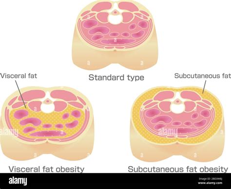 Type of obesity illustration. Abdominal sectional View. (visceral fat , subcutaneous fat Stock ...