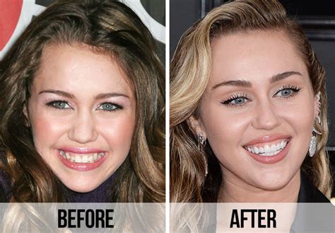 21 Celebrity Dental Implants And Veneers: Before And After - SHEfinds
