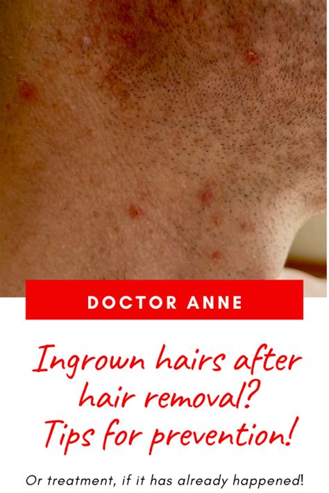 the-secret-to-preventing-ingrown-hairs-ask-doctor-anne