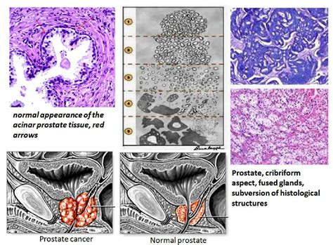 Prostate Cancer Histology