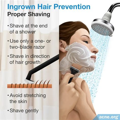 What Are Ingrown Hairs? - Acne.org
