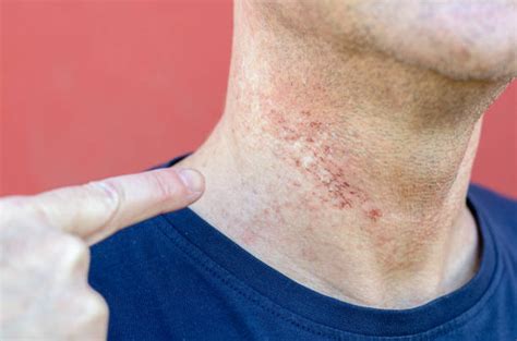 Shaving Irritation Stock Photos, Pictures & Royalty-Free Images - iStock
