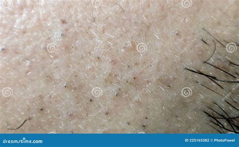 Closeup of Caucasian Skin with Ingrown Hair and Man Short Beard. Close Up of Caucasian Skin with ...