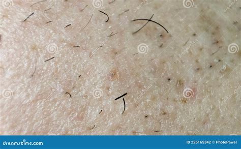 Closeup of Caucasian Skin with Ingrown Hair and Man Short Beard. Close ...