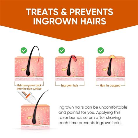 Ingrown Hair Treatment &amp; Razor Bumps Stopper Serum - Alcohol-Free After ...