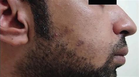 How To Deal With Razor Bumps - Skirtdiamond27