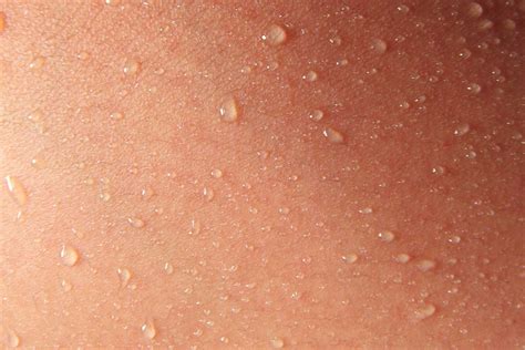 How To Deal With Excessive Sweating - The London Dermatologist