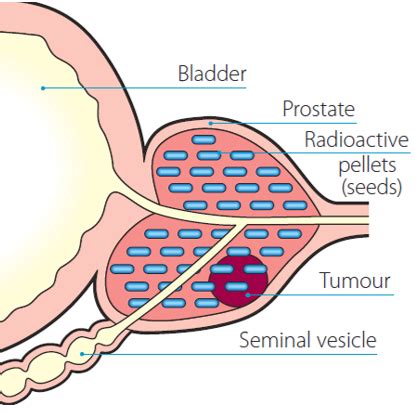What specific dietary patterns or food groups have been consistently linked to a reduced risk of prostate cancer in men?