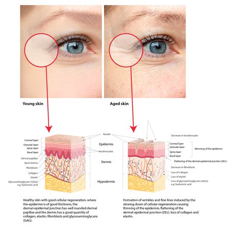 Epidermis And Dermis Layers Of Skin