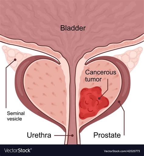 Stage 2 Prostate Cancer Treatment Options at Bonnie Tyler blog
