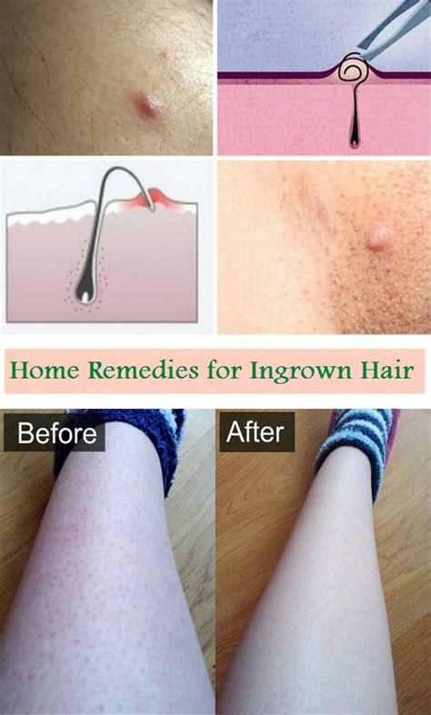 Home Remedies for Ingrown Hair - BEAUTIFUL DIY AND HEALTH