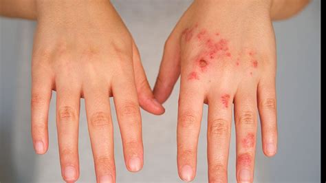 Lebrikizumab reçoit le feu vert de l’Europe pour le traitement de la dermatite atopique modérée ...
