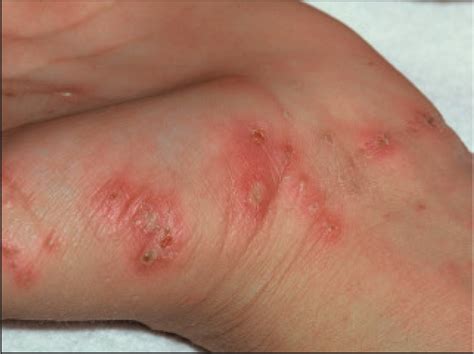 Scabies Under Magnifying Glass