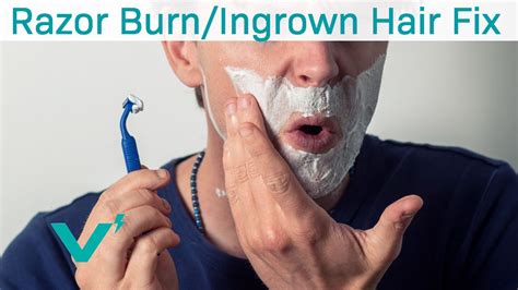 Optimal shave strategy to eliminate razor burn and ingrowns?