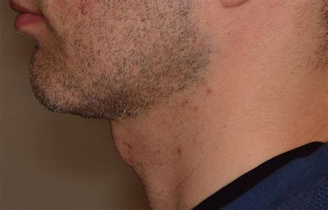 Razor Burn From Electric Razor: Causes, Solutions &amp; Preventions Handbook