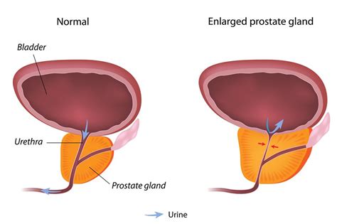 Prostate Diagram And Function Prostate Prostata Zones Gland