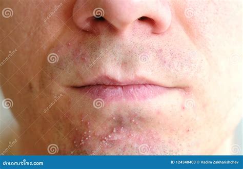Skin Irritation after Shaving on Man`s Skin. Closeup Nose and Lips ...