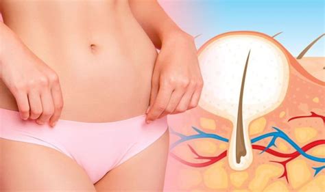 How to get rid of ingrown hairs: Expert’s ‘go-to’ exfoliating treatment ...