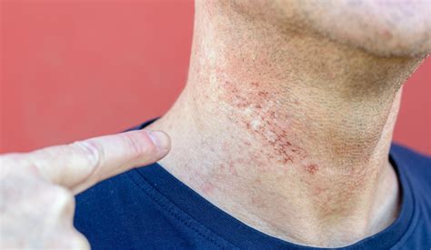Best razor/technique to stop ingrown hairs on neck?