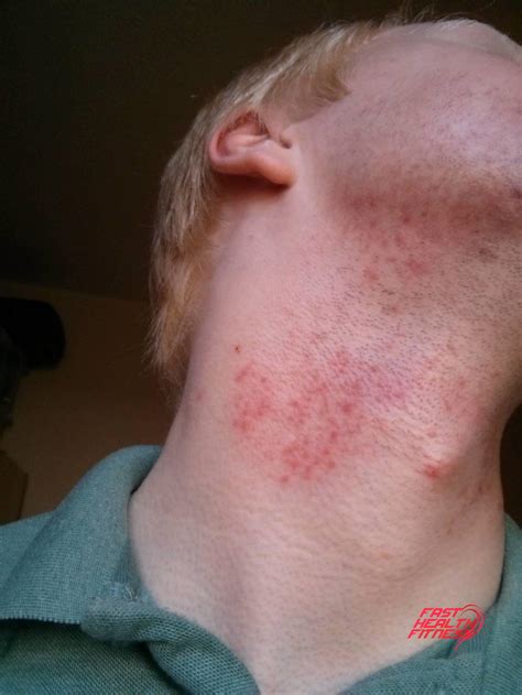 How to prevent razor burn on neck?