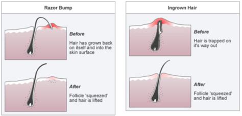 Best method to prevent recurring ingrown hairs after shaving?