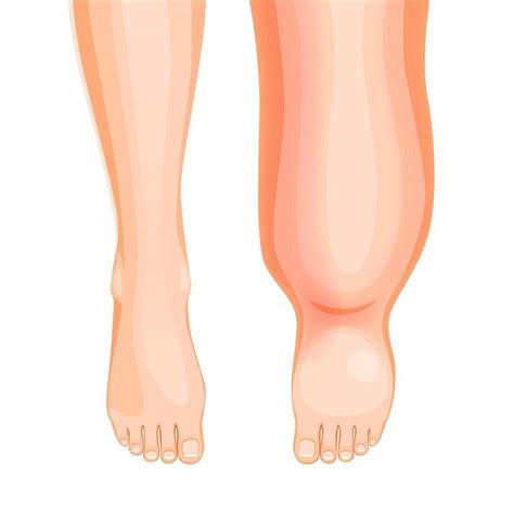 Edema foot disease, swollen leg symptom or problem 21948732 Vector Art at Vecteezy