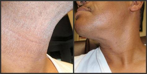 Dry skin from shaving (before) and nice clear beautiful skin (after ...