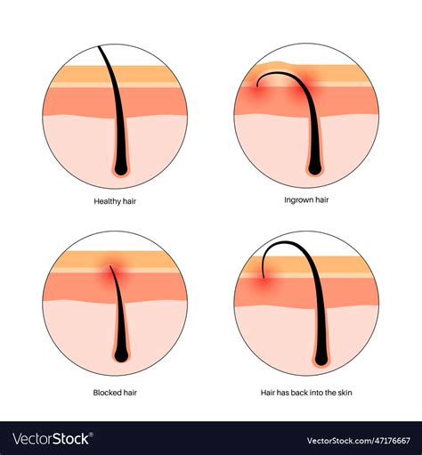 Ingrown hair inflammation Royalty Free Vector Image