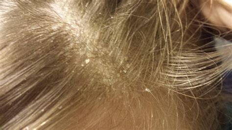 Help! My dandruff is insanely bad, and I don't want to use shampoo if I ...