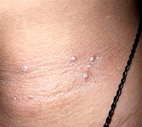 Weird painful bumps on my neck, What is this? Im paranoid rn. : r/SkincareAddicts