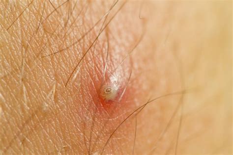 How to Get Rid of Ingrown Hair