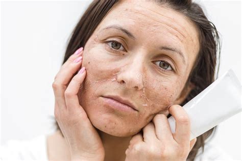 Cropped Photo of Woman with Dry Skin and Cream on White Background ...