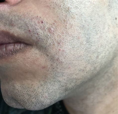 Optimal shaving technique to eliminate razor burn & ingrown hairs for peak performance?