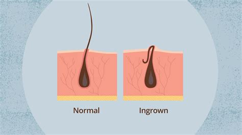 Black Men Ingrown Facial Hair