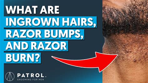 Ingrown Hairs, Razor Bumps, Razor Burn &amp; Irritation