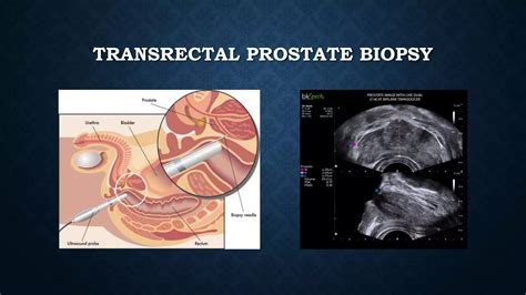Prostate Biopsy.pptx | Physical Therapy | Wellness