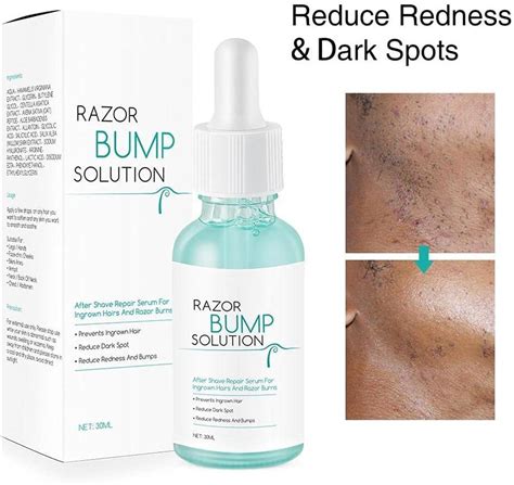 CeFoney Skin Dent Ingrown Hair Prevention Serum - Razor Bump & After Shave Solution (30ml) | Buy ...