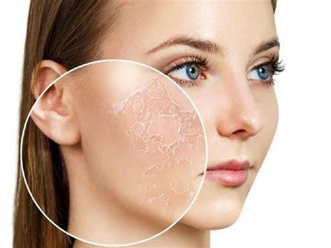 Winter Care For Dry, Flaky, Skin: The Right Care Can Make All The Difference | TheHealthSite.com
