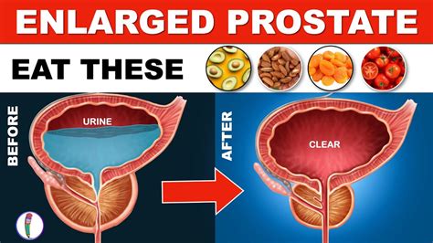 Enlarged Prostate