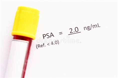 Normal PSA test result stock photo. Image of elder, laboratory - 180815116