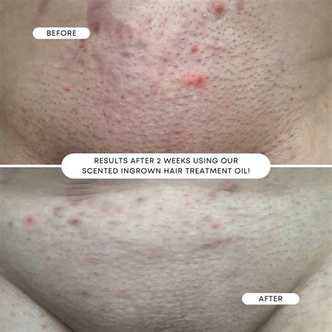 Optimal shave: how to eliminate razor burn and ingrowns for peak skin performance?
